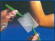 Pharmatull, pansament tip plasa cu parafina